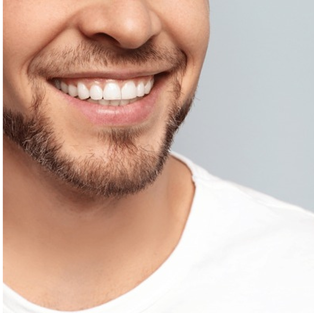 هوليوود سمايل (فينير – زيركون)